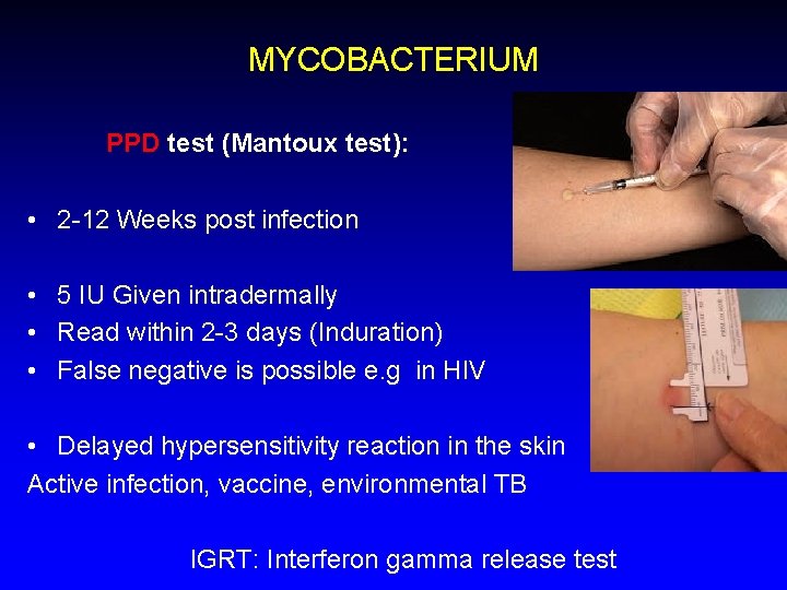 MYCOBACTERIUM PPD test (Mantoux test): • 2 -12 Weeks post infection • 5 IU