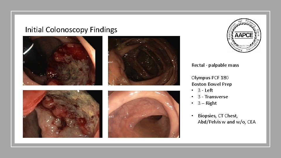 Initial Colonoscopy Findings Rectal - palpable mass Olympus PCF 180 Boston Bowel Prep •