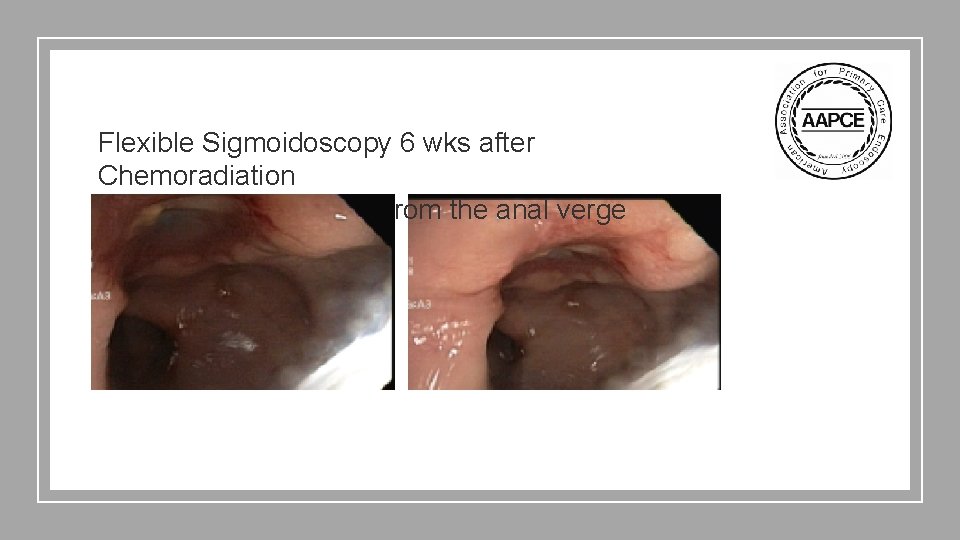 Flexible Sigmoidoscopy 6 wks after Chemoradiation Low ulcers noted 4 cm from the anal