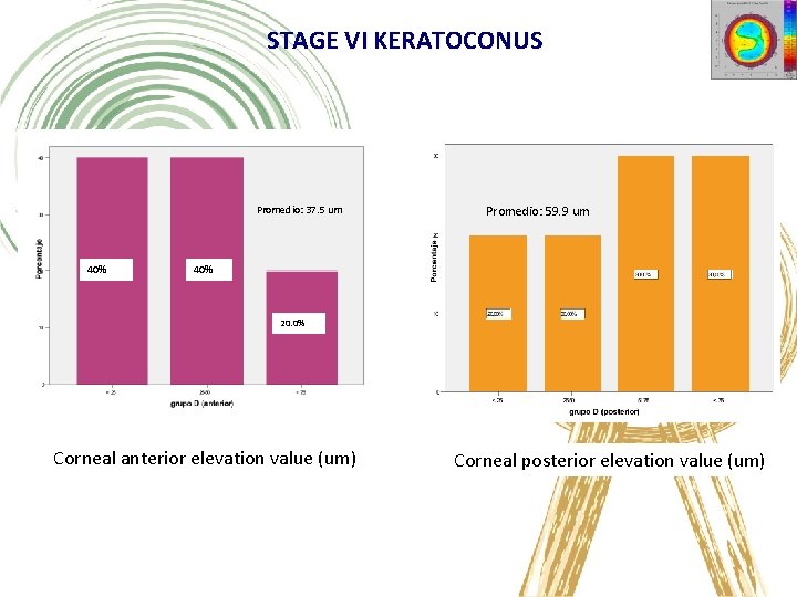 STAGE VI KERATOCONUS Promedio: 37. 5 um 40% Promedio: 59. 9 um 40% 20.