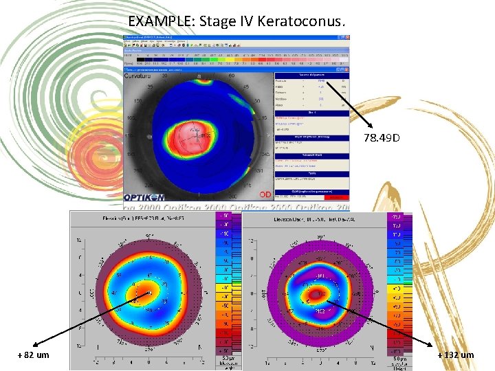 EXAMPLE: Stage IV Keratoconus. 78. 49 D + 82 um + 132 um 