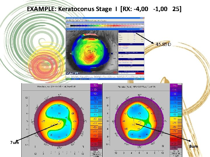 EXAMPLE: Keratoconus Stage I [RX: -4, 00 -1, 00 25] 45. 85 D 8