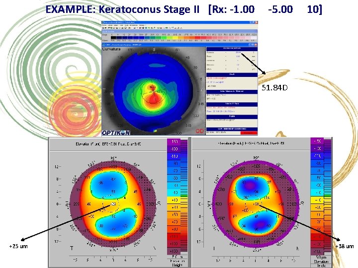 EXAMPLE: Keratoconus Stage II [Rx: -1. 00 -5. 00 10] 51. 84 D +25