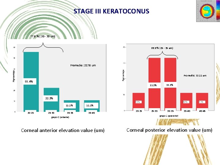 STAGE III KERATOCONUS 77. 8 % ( 20 - 30 um) 66. 6 %