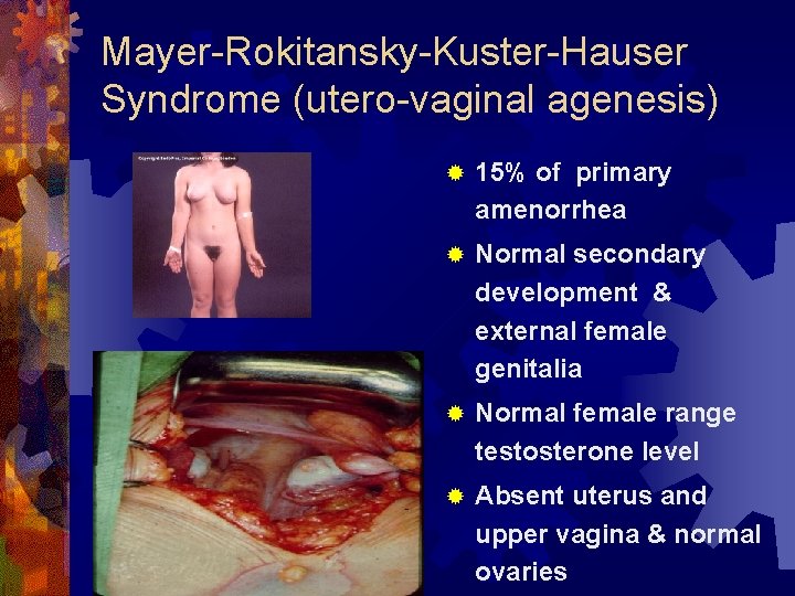 Mayer-Rokitansky-Kuster-Hauser Syndrome (utero-vaginal agenesis) ® 15% of primary amenorrhea ® Normal secondary development &