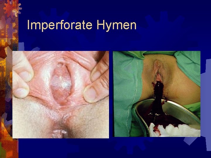 Imperforate Hymen 