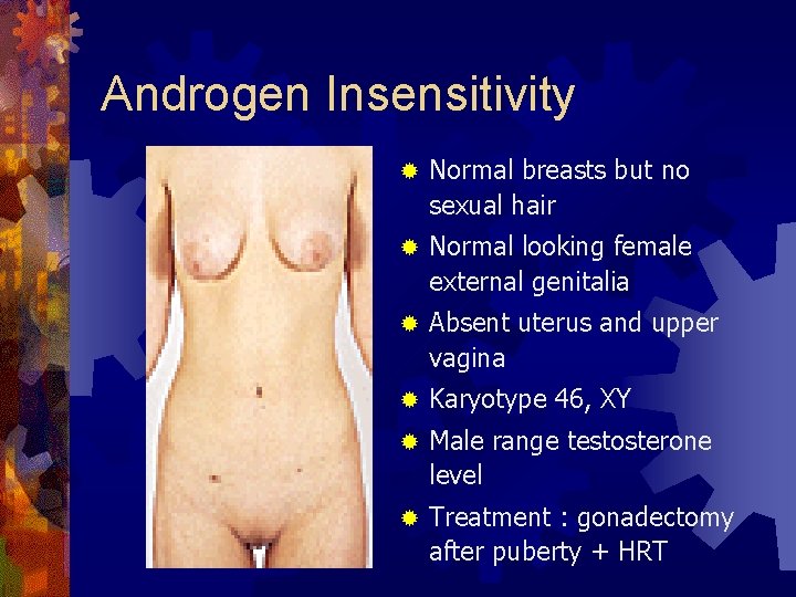 Androgen Insensitivity ® Normal breasts but no sexual hair ® Normal looking female external