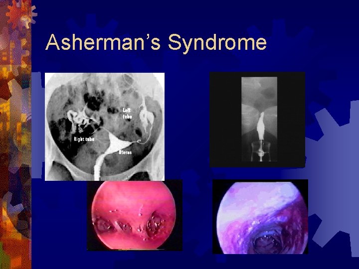 Asherman’s Syndrome 