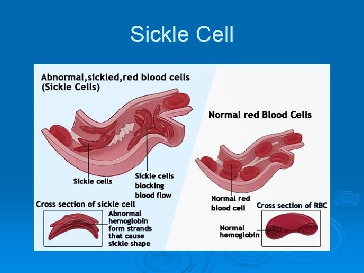 Sickle Cell 