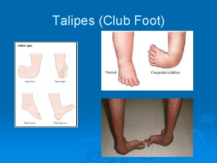 Talipes (Club Foot) 