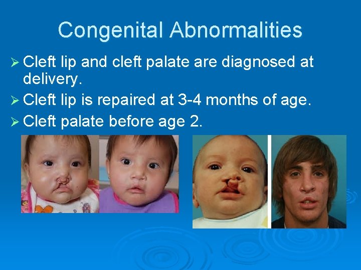 Congenital Abnormalities Ø Cleft lip and cleft palate are diagnosed at delivery. Ø Cleft