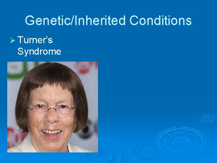 Genetic/Inherited Conditions Ø Turner’s Syndrome 