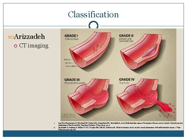 Classification Arizzadeh CT imaging 1. 2. Lee WA, Matsumura JS, Mitchell RS, Farber MA,