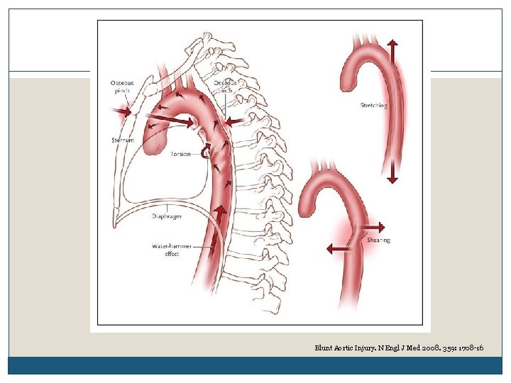 Blunt Aortic Injury. N Engl J Med 2008. 359: 1708 -16 