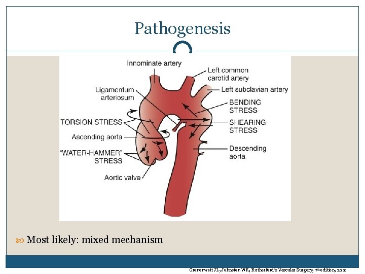 Pathogenesis Most likely: mixed mechanism Cronenwett JL, Johnston WK, Rutherford’s Vascular Surgery, 7 th