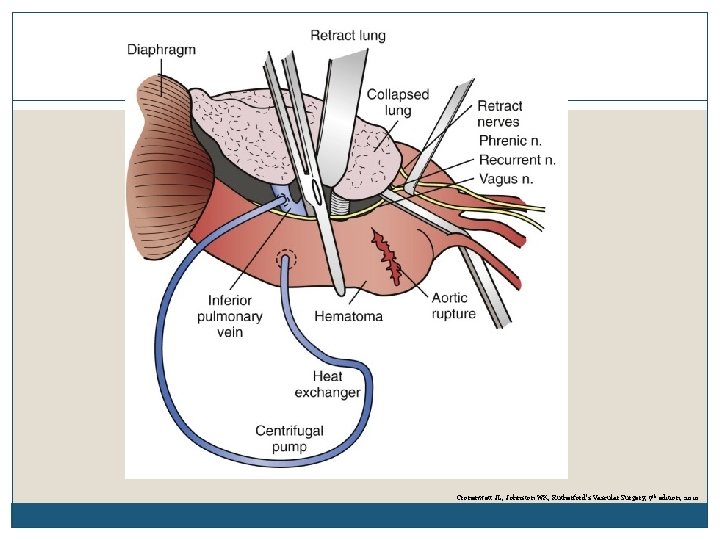 Cronenwett JL, Johnston WK, Rutherford’s Vascular Surgery, 7 th edition, 2010 