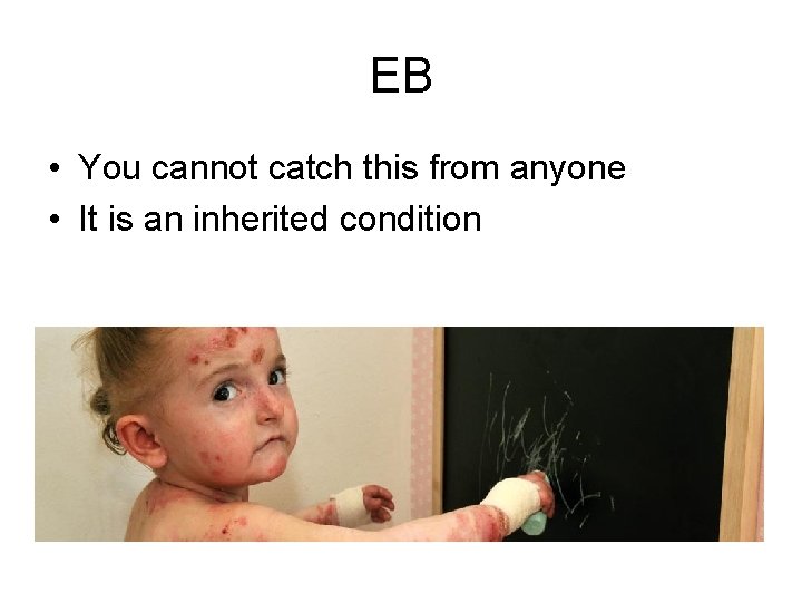 EB • You cannot catch this from anyone • It is an inherited condition