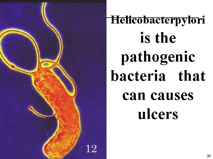 Helicobacterpylori is the pathogenic bacteria that can causes ulcers 38 