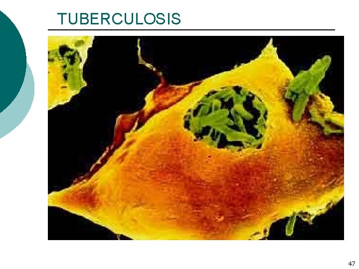 TUBERCULOSIS 47 