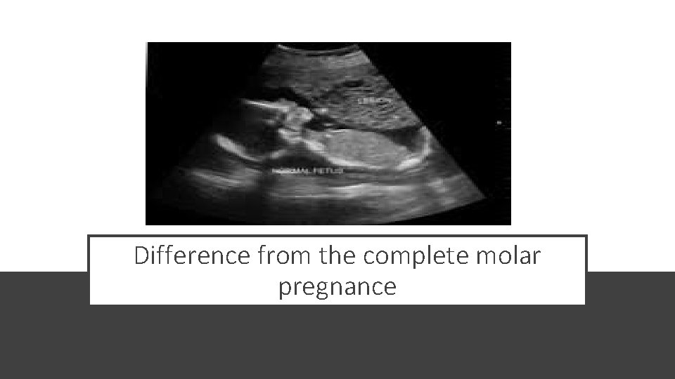 Difference from the complete molar pregnance 