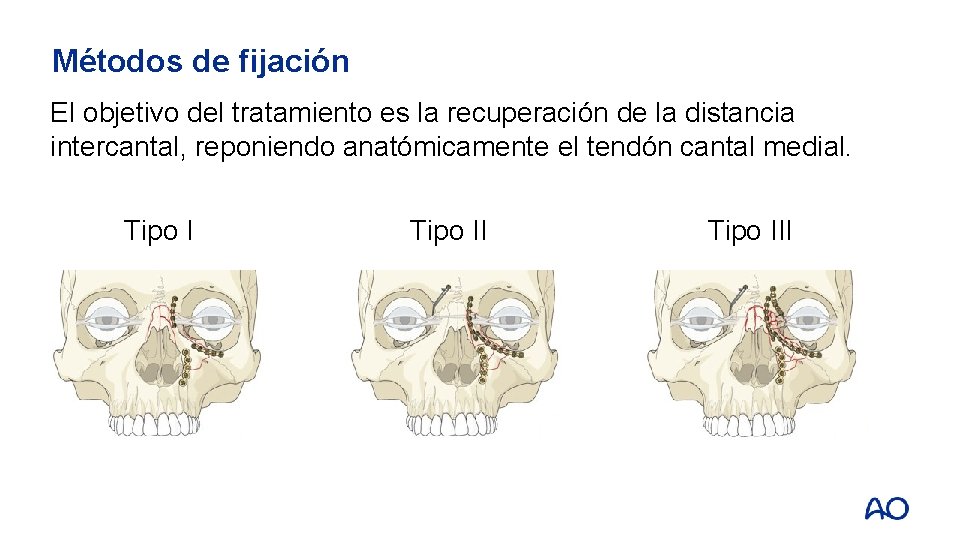 Métodos de fijación El objetivo del tratamiento es la recuperación de la distancia intercantal,