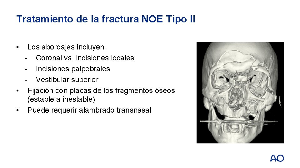 Tratamiento de la fractura NOE Tipo II • Los abordajes incluyen: - Coronal vs.