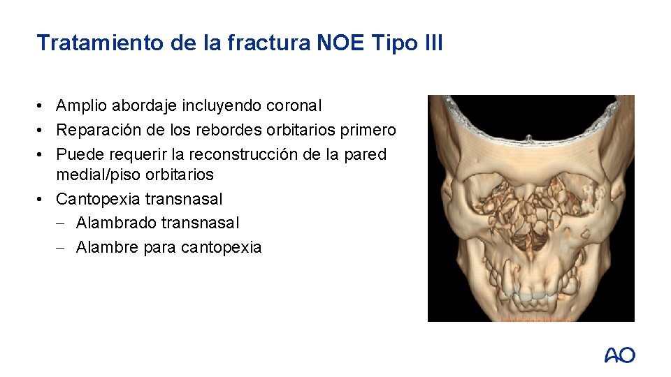 Tratamiento de la fractura NOE Tipo III • Amplio abordaje incluyendo coronal • Reparación