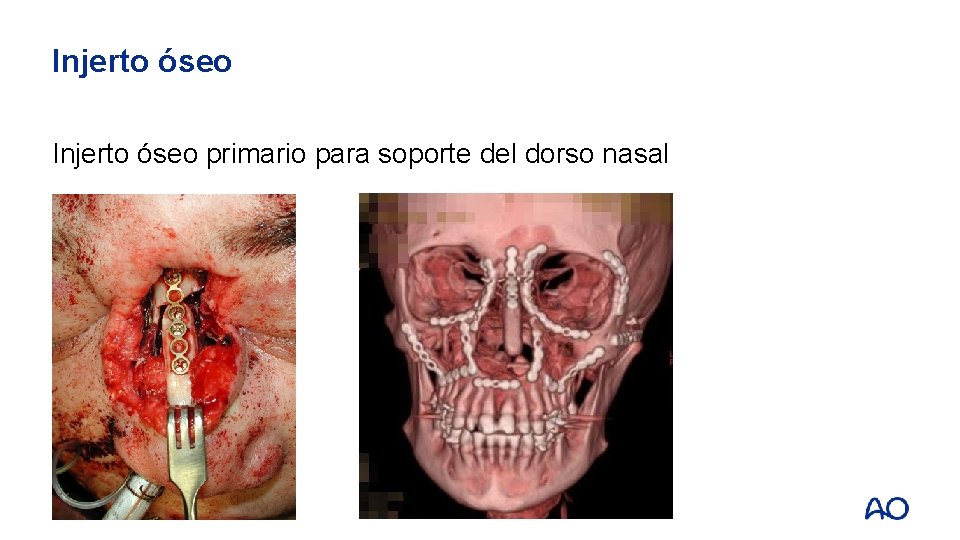 Injerto óseo primario para soporte del dorso nasal 
