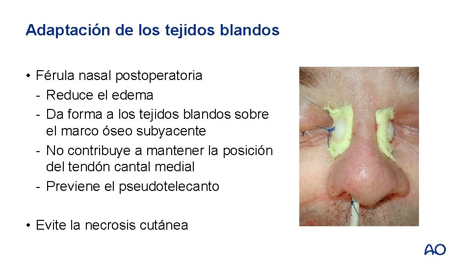 Adaptación de los tejidos blandos • Férula nasal postoperatoria - Reduce el edema -