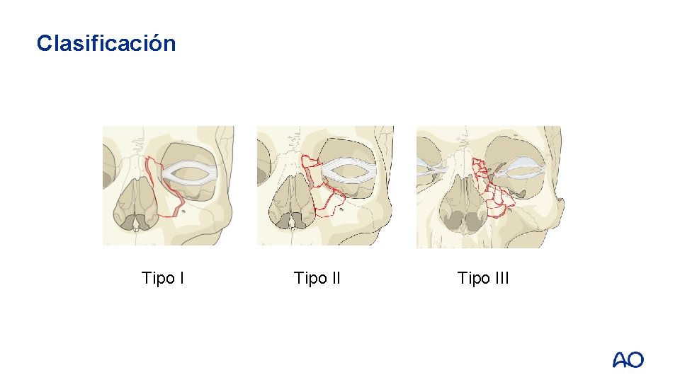 Clasificación Tipo III 