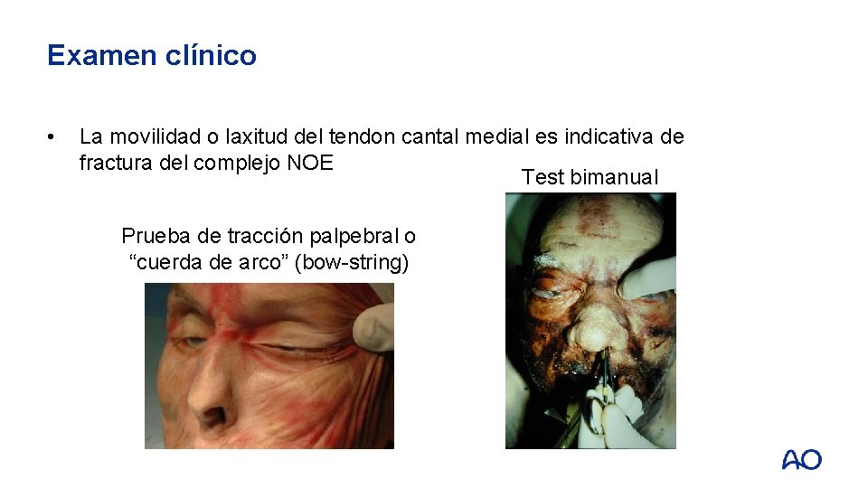 Examen clínico • La movilidad o laxitud del tendon cantal medial es indicativa de