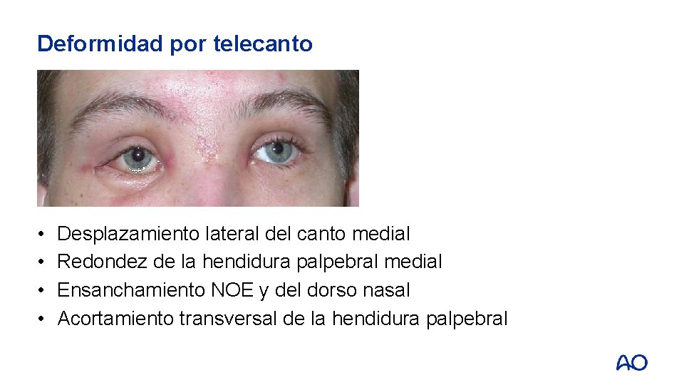 Deformidad por telecanto • • Desplazamiento lateral del canto medial Redondez de la hendidura