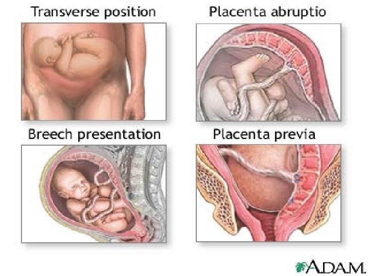 FETAL INDICATION • Fetal distress and cord prolapse • Breech presentation –[footling, knee presentation,