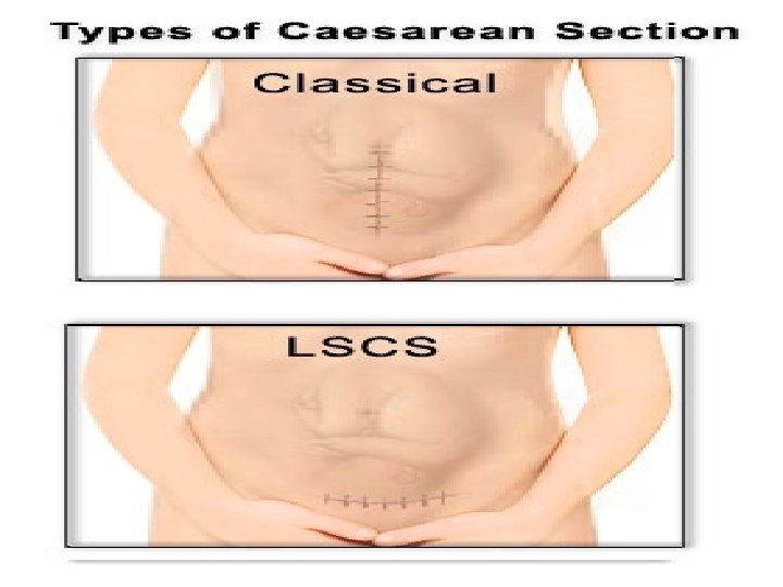 Classical CS - Disadvantages • Chance of scar rupture more • General peritonitis ,