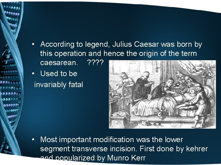  • According to legend, Julius Caesar was born by this operation and hence