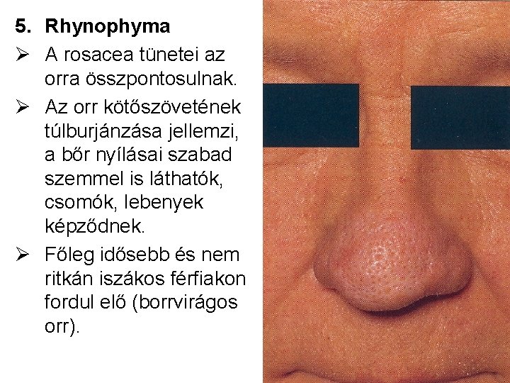 5. Rhynophyma Ø A rosacea tünetei az orra összpontosulnak. Ø Az orr kötőszövetének túlburjánzása