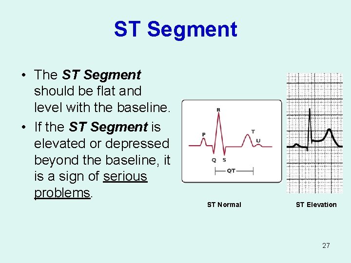 ST Segment • The ST Segment should be flat and level with the baseline.