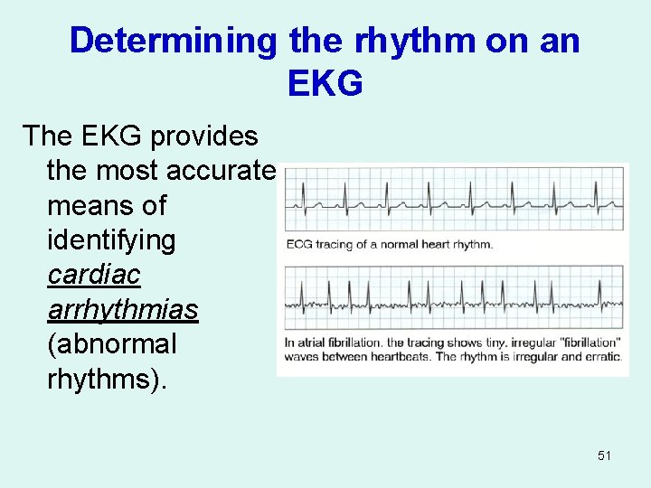 Determining the rhythm on an EKG The EKG provides the most accurate means of