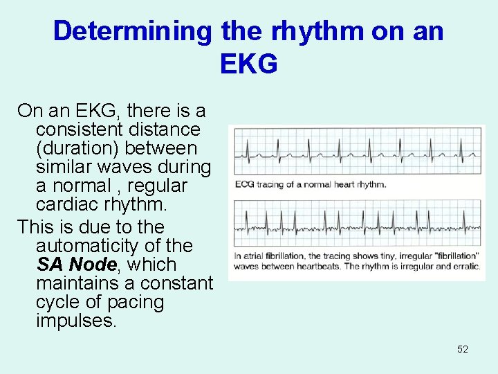 Determining the rhythm on an EKG On an EKG, there is a consistent distance