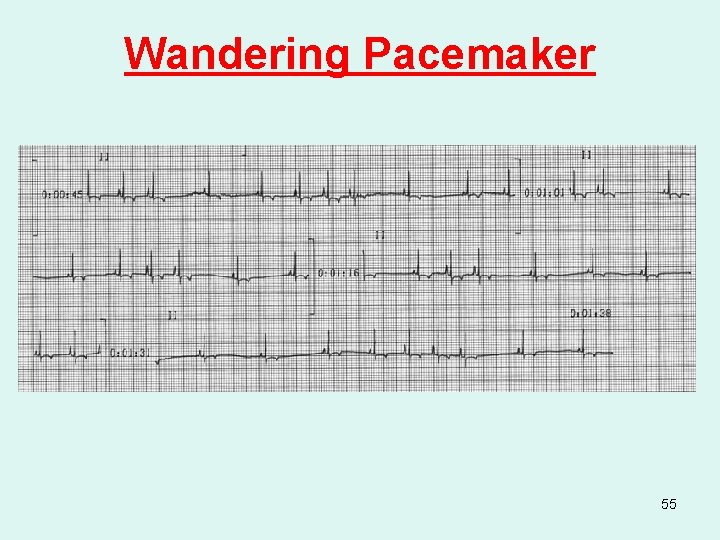 Wandering Pacemaker 55 
