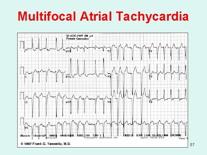 Multifocal Atrial Tachycardia 57 