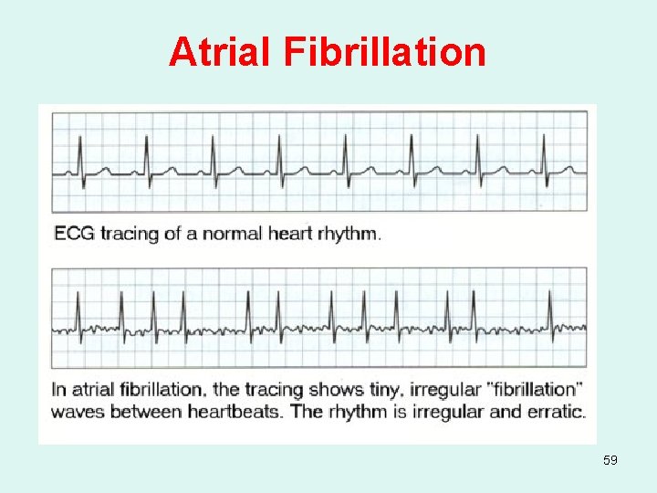 Atrial Fibrillation 59 