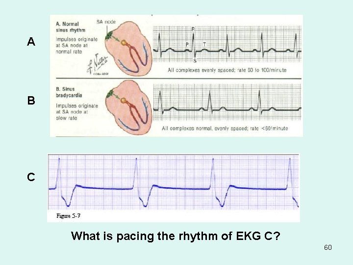 A B C What is pacing the rhythm of EKG C? 60 