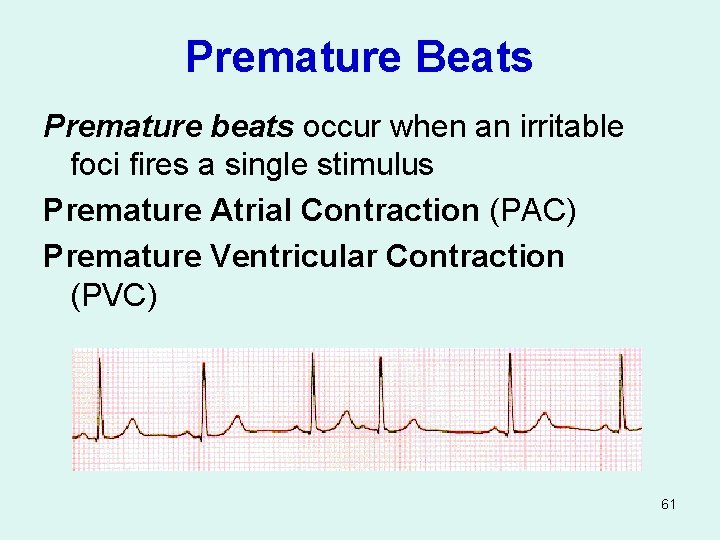 Premature Beats Premature beats occur when an irritable foci fires a single stimulus Premature