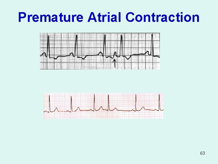Premature Atrial Contraction 63 