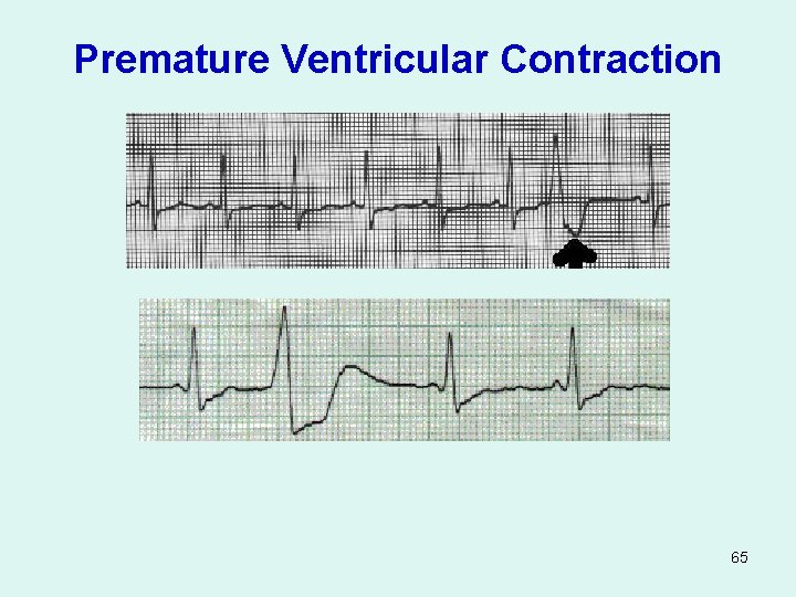 Premature Ventricular Contraction 65 