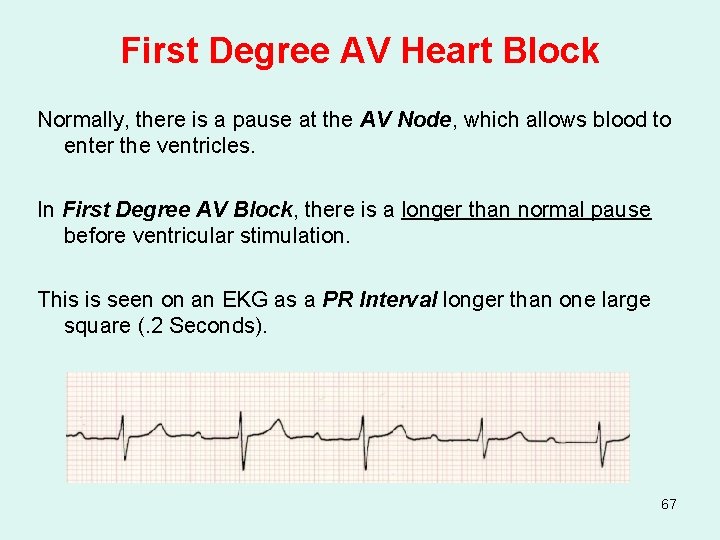 First Degree AV Heart Block Normally, there is a pause at the AV Node,