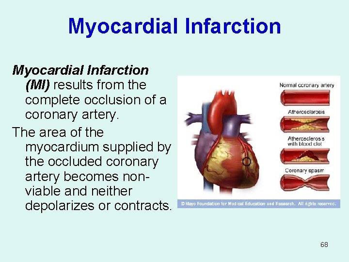 Myocardial Infarction (MI) results from the complete occlusion of a coronary artery. The area
