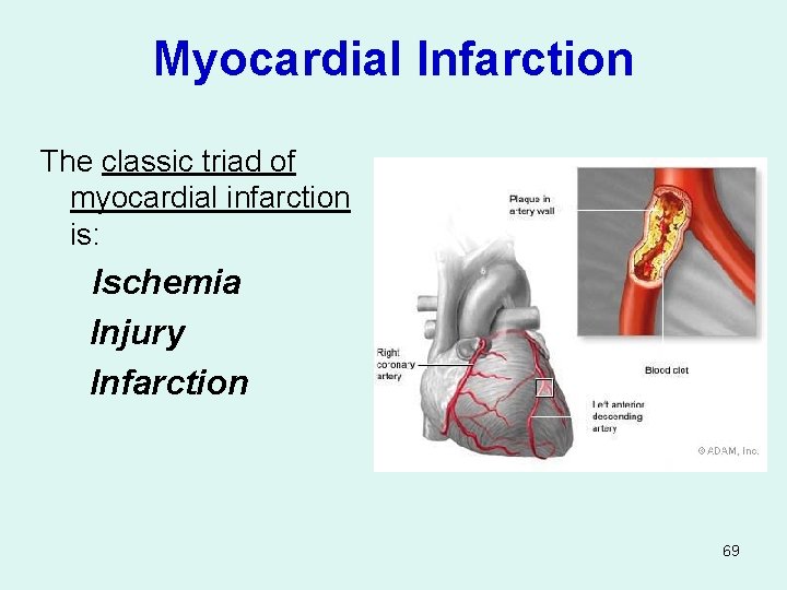 Myocardial Infarction The classic triad of myocardial infarction is: Ischemia Injury Infarction 69 