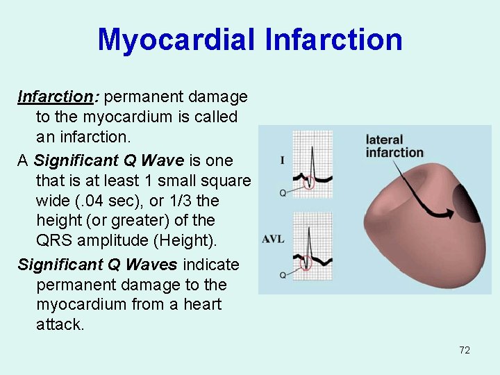 Myocardial Infarction: permanent damage to the myocardium is called an infarction. A Significant Q